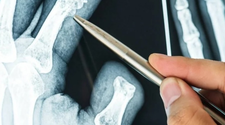 Bone-02: клей для костей, ускоряющий заживление переломов всего за 3 минуты