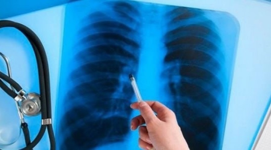 Флюорография выявляет до 60% случаев туберкулёза на ранней стадии в ПМР