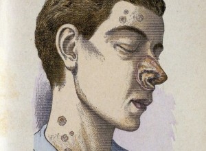 Тёмная сторона Ренессанса: сифилис и «эпоха зомби» в Европе