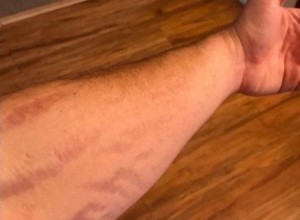 Почему на шрамах не растут волосы и не работают потовые железы