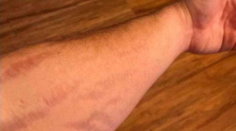 Почему на шрамах не растут волосы и не работают потовые железы